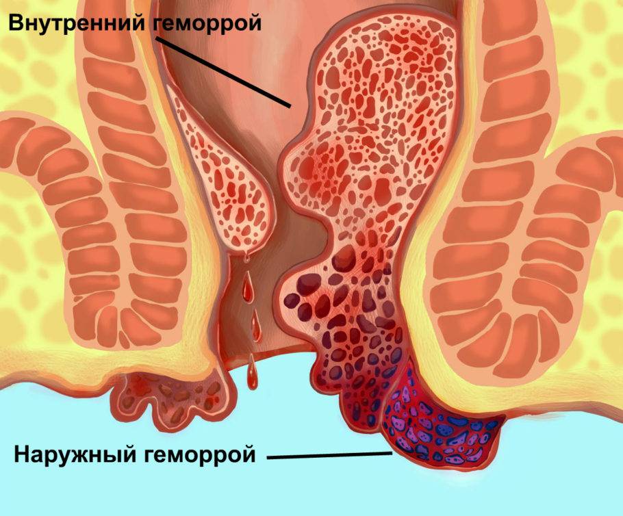 Стадии и причины появления геморроя, как правильно избавиться от геморроя? зачем вам этот геморрой?