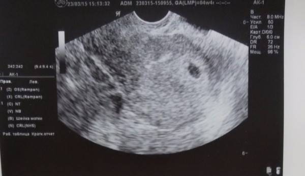 Узи на 3 неделе беременности: фото плода, что покажет, можно ли делать