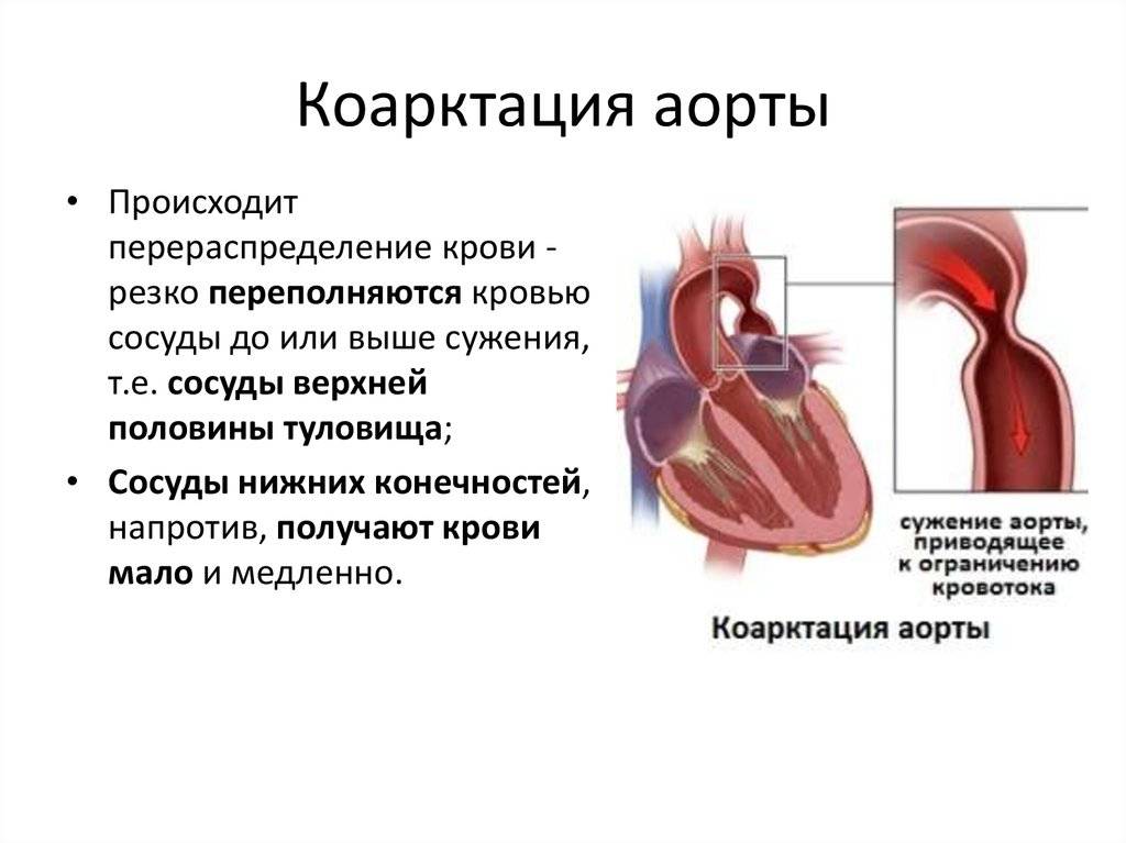 Коарктация аорты — википедия. что такое коарктация аорты