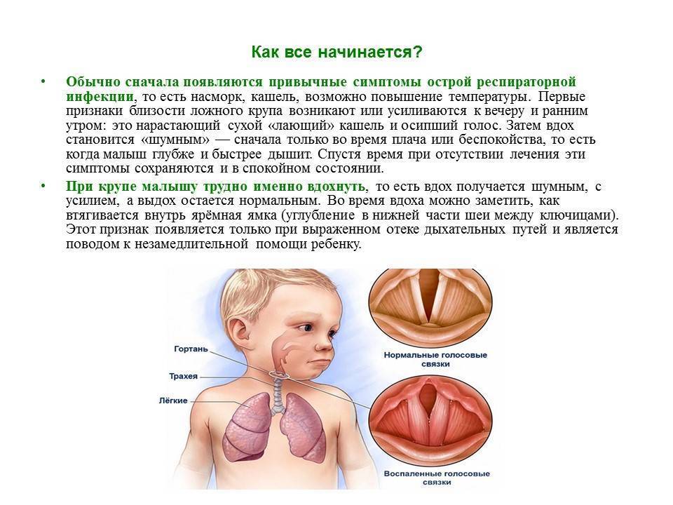 Ларингит у детей: симптомы и лечение - medside.ru