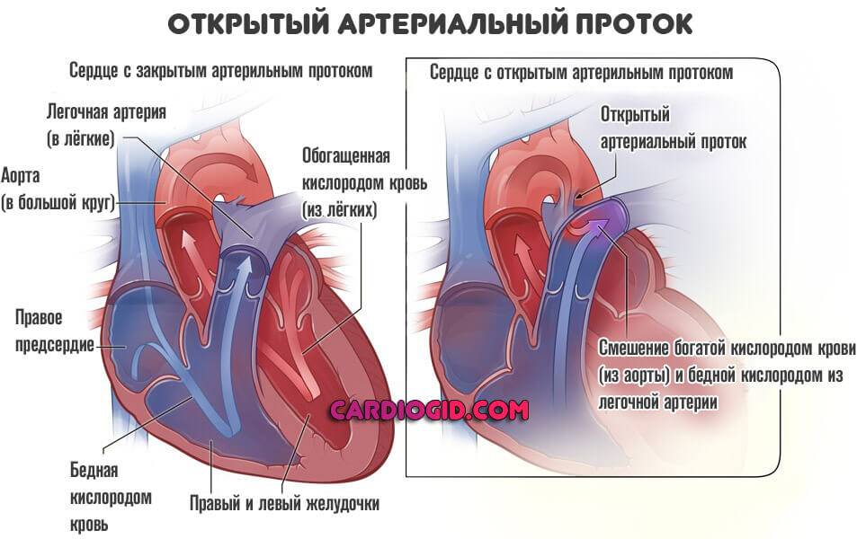 Врожденные пороки сердца (открытый артериальный проток, тетрада фалло, коарктация аорты, дефект межжелудочковой перегородки)