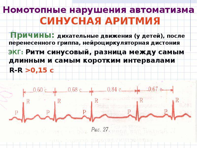 Пролапс митрального клапана сердца, лечение пролапса митрального клапана 1, 2, 3 степени у женщин и мужчин с регургитацией на экг