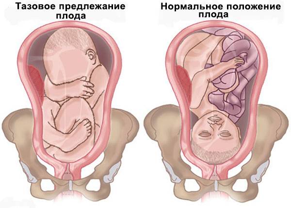 Можно ли узнать самой, как лежит ребенок в животе матери? - беременность