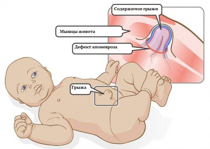 Доктор Комаровский о пупочной грыже у новорожденных и маленьких детей