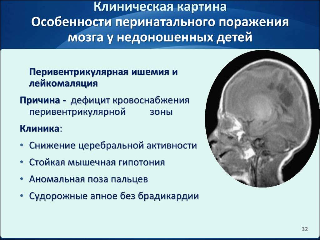 Ишемия головного мозга: диагностика, лечение и профилактика