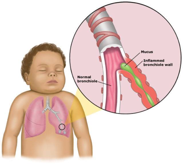 Выбор лекарств для детей с острыми инфекциями дыхательных путей