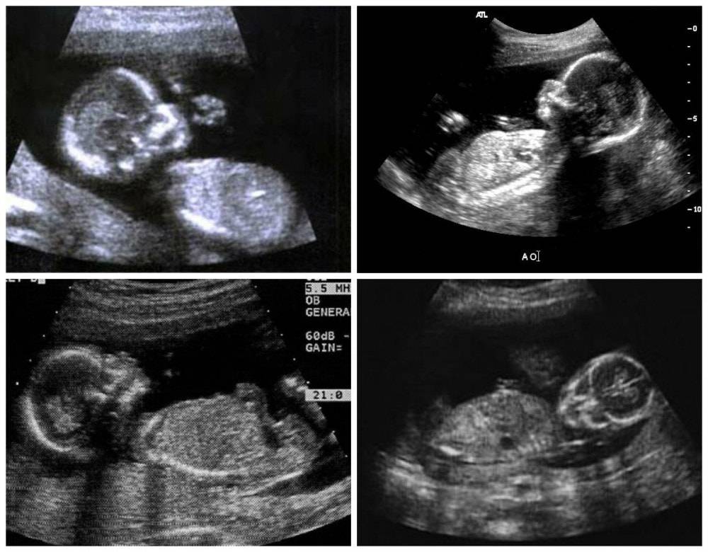 Фото узи ребенка на разных сроках беременности * клиника диана