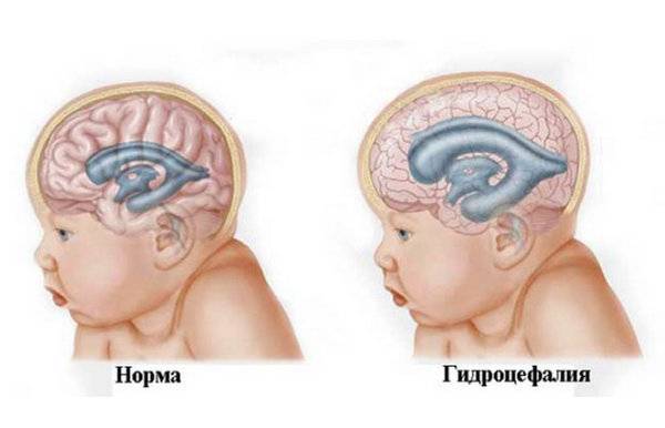Ишемия головного мозга у новорожденного