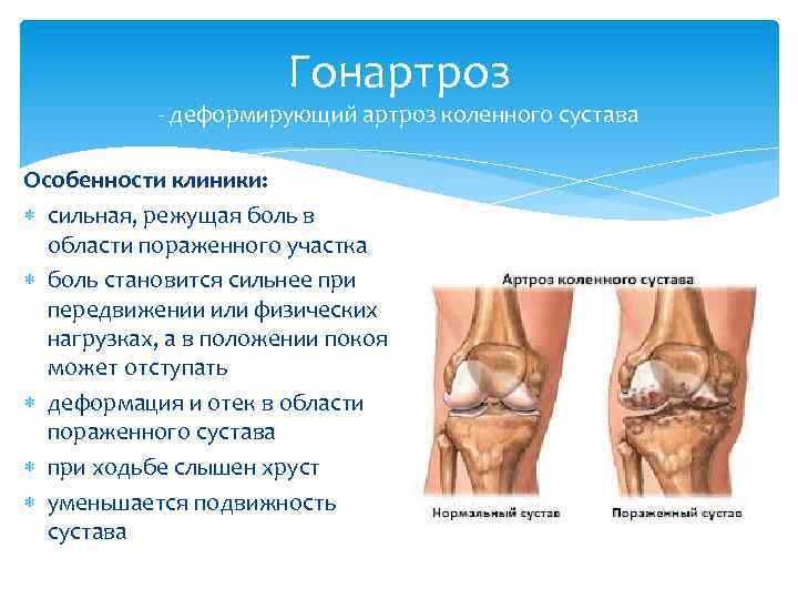 Каковы риски операции по замене коленного сустава?