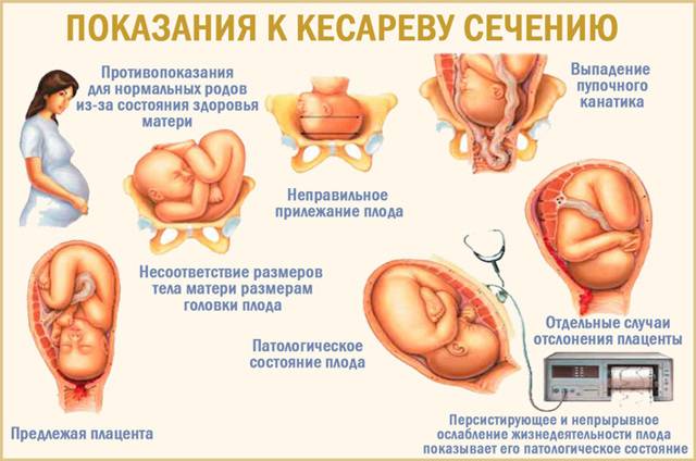 Не раз и не два. повторные операции кесарева сечения   | материнство - беременность, роды, питание, воспитание