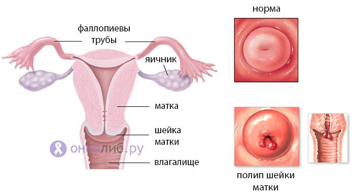 Цервикальный канал при беременности: состояние в норме и возможные патологии