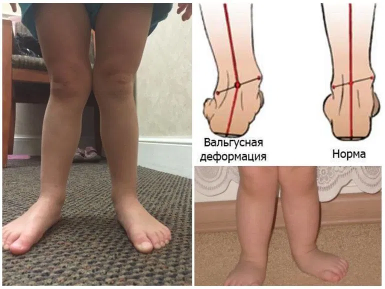 Плоскостопие у детей | фото до и после, операция, отзывы, лечение, реабилитация и восстановление