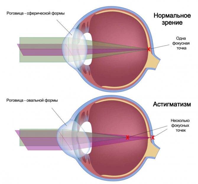 Что такое смешанный астигматизм глаз? методы лечения заболевания