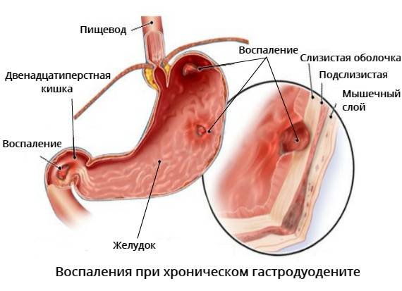 Хронический гастродуоденит | itvm.ru институт традиционной восточной медицины