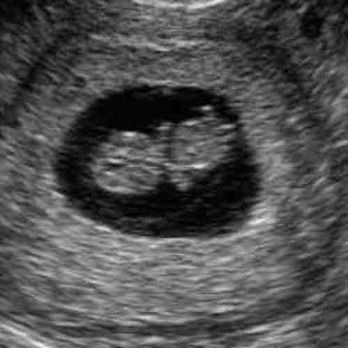 На 9 неделе появляется. 9 Недель беременности фото плода на УЗИ. УЗИ на 9 неделе беременности плода на УЗИ. Эмбрион на 9 неделе беременности УЗИ. Снимок УЗИ на 9 неделе беременности.