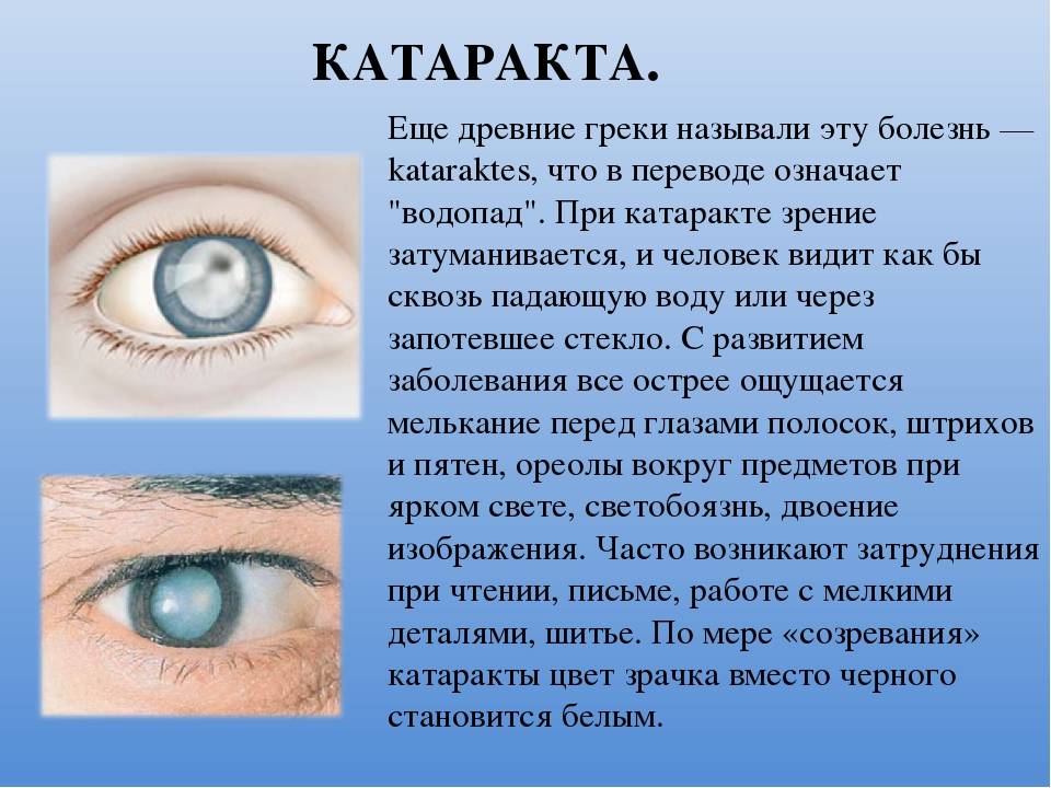 Становятся видимыми глазом. Катаракта глаза симптомы. Сообщение о заболеваниях глаз. Болезни органов зрения и их профилактика.