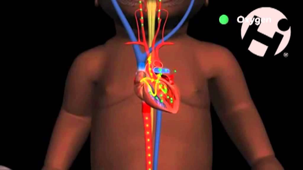 Что такое гиперэхогенный фокус в желудочке сердца у плода