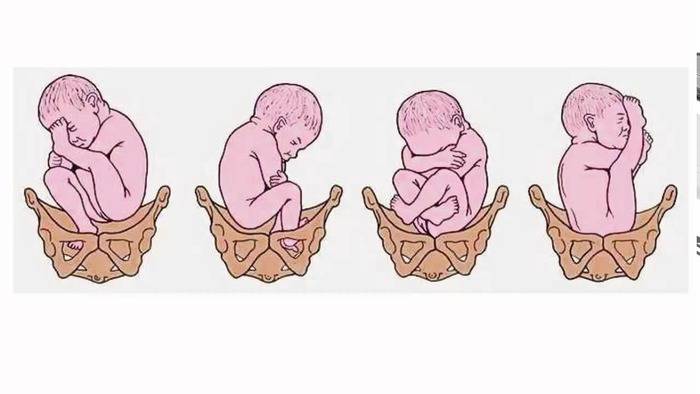 Упражнения для беременных, чтобы ребенок перевернулся головкой вниз: какая гимнастика желательна при тазовом предлежании плода и есть ли ограничения для зарядки?