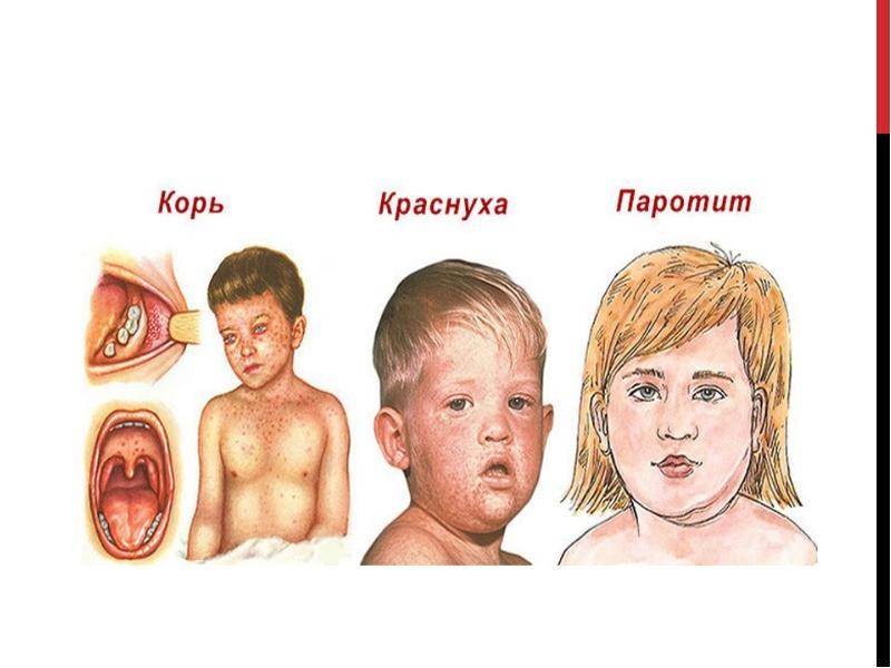Эпидемический паротит у детей - симптомы болезни, профилактика и лечение эпидемического паротита у детей, причины заболевания и его диагностика на eurolab
