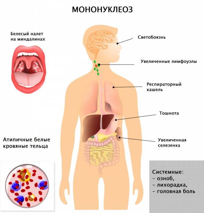 Инфекционный мононуклеоз у детей