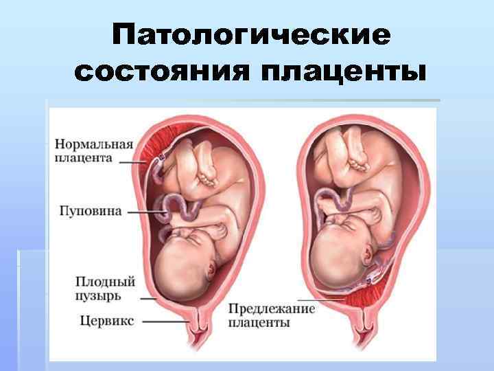 Оболочечное, краевое и боковое прикрепление пуповины: как рожают при оболочной и эксцентричной, центральной формах, последствия для ребенка