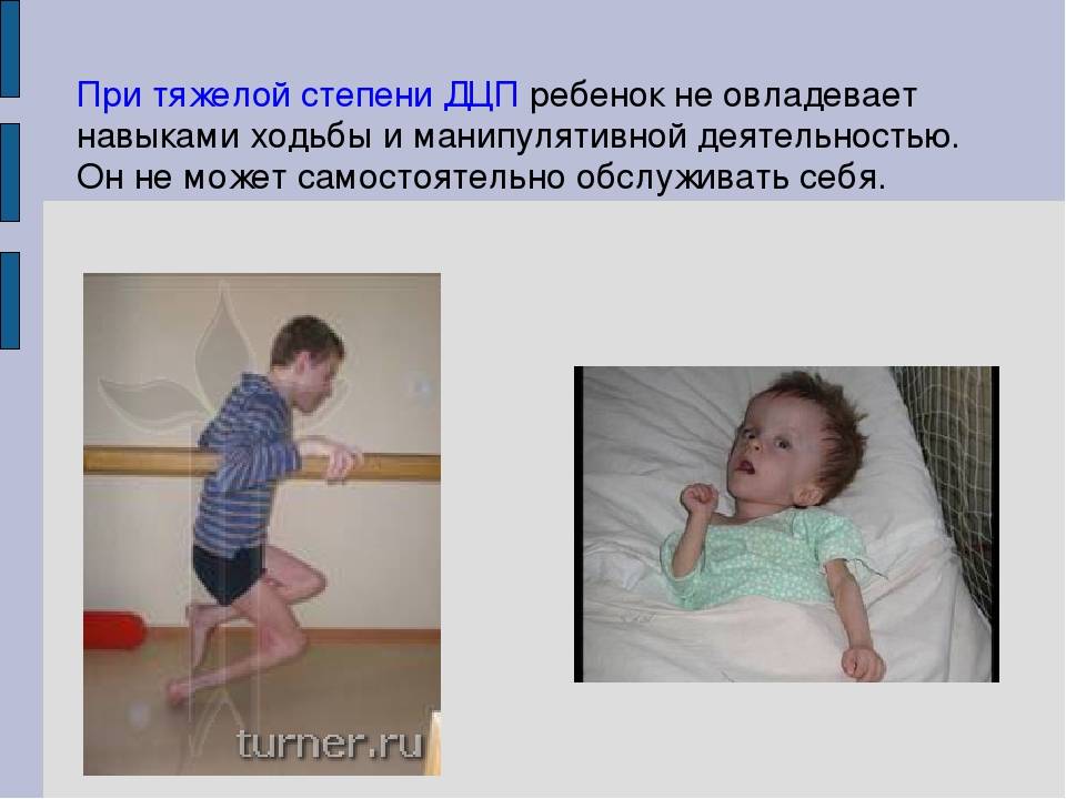 Детский церебральный паралич (дцп)