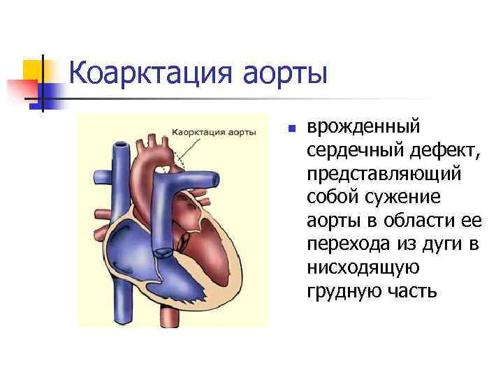 Стеноз аорты у детей презентация