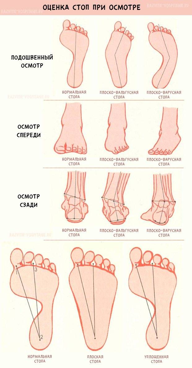 Вальгусная деформация стопы что это такое фото