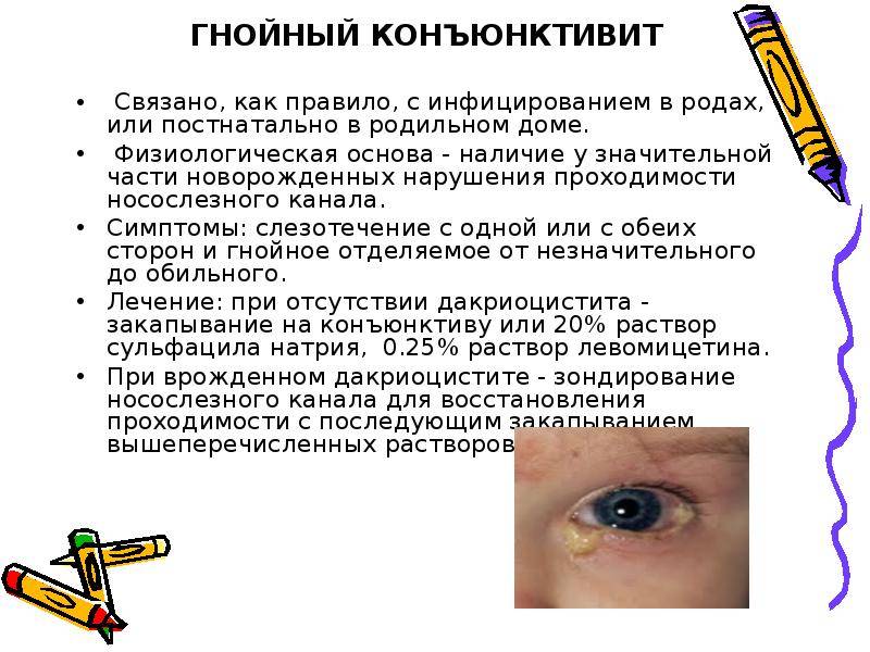 Конъюнктивит у детей: причины, признаки, лечение «ochkov.net»