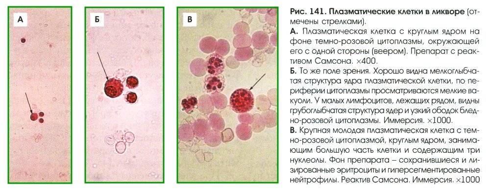 Иммуногистохимическое исследование хронического эндометрита с типированием плазматических клеток (cd138)