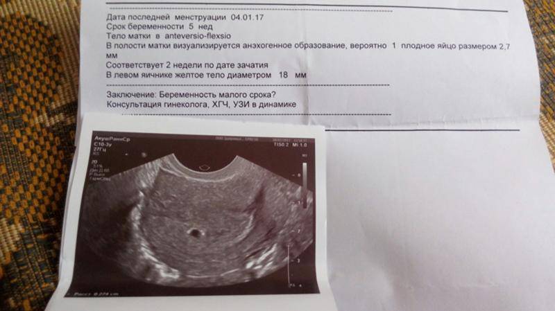 Предполагаемая дата зачатия. акушерский срок беременности.