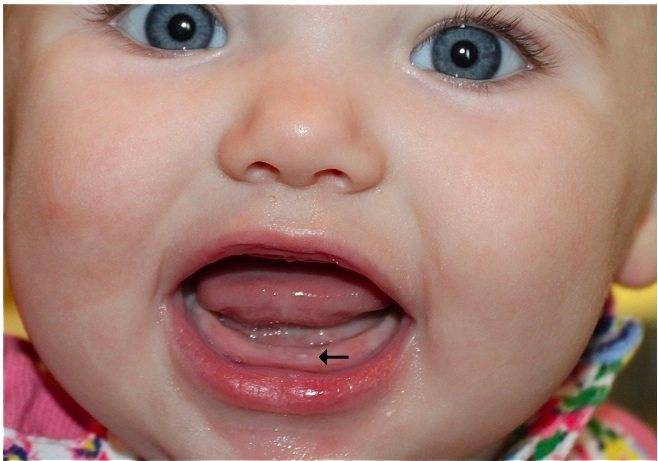 Понос при прорезывании зубов у детей:сколько дней, что делать, чем лечить жидкий стул. | elesto.ru