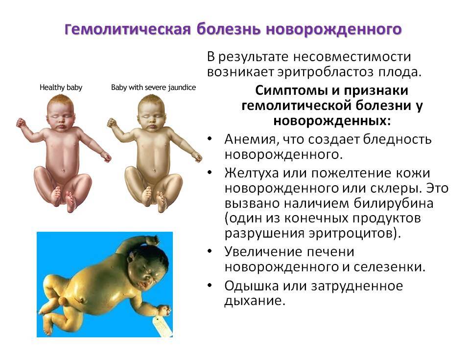 Гемолитическая болезнь новорожденного                (эритробластоз плода, фетальный эритробластоз)