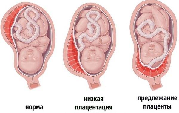 Как выглядит плацента и где она прикрепляется?