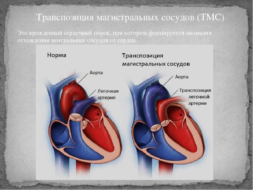 Диагноз марс в кардиологии у детей – это норма или патология?