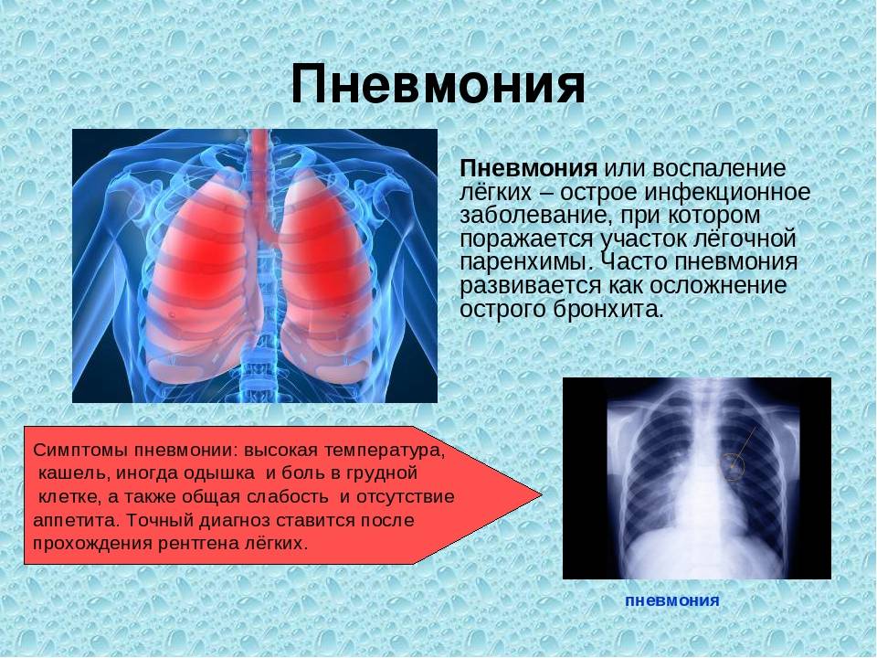 Причины пневмонии у детей