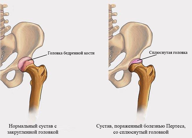Синовит тазобедренного сустава : симптомы и лечение синовита тазобедренного сустава | компетентно о здоровье на ilive