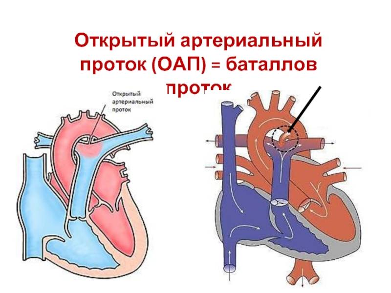 Открытый артериальный проток