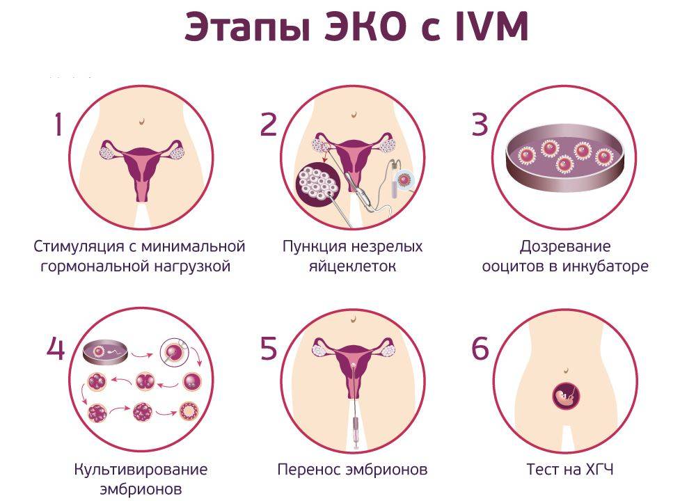 Подсадка (перенос) эмбрионов при эко >>> эмбриотрансфер