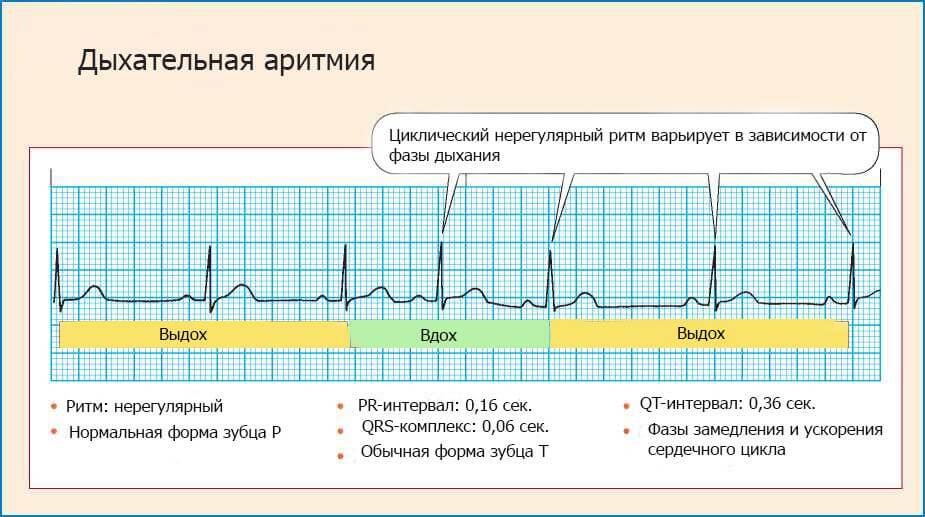 Нарушение ритма сердца, причины и лечение нарушения ритма сердца с диагностикой в центре