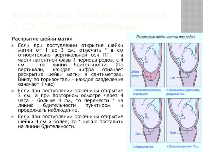 Короткая шейка матки при беременности — медицинский женский центр в москве