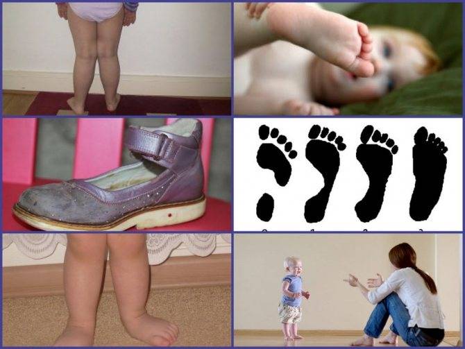 Особенности ортопедических стелек для детей при лечении вальгусной деформации стоп
