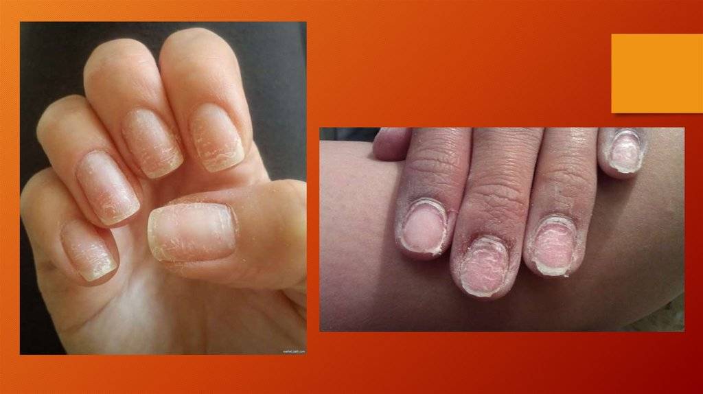 Гель лак при беременности (14 фото): мнение врачей о гель-лаке при беременности. как влияет покрытие на ногтях?