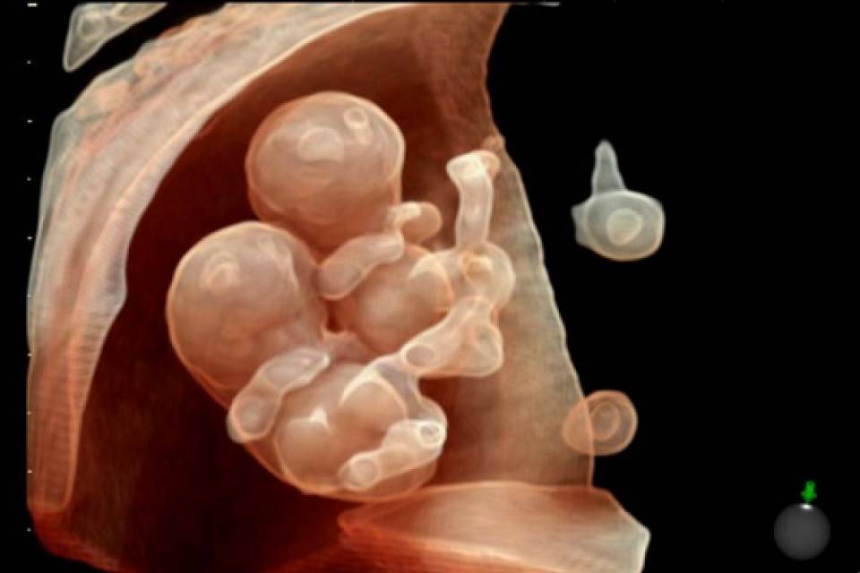 Многоплодие: признаки и патологии многоплодной беременности