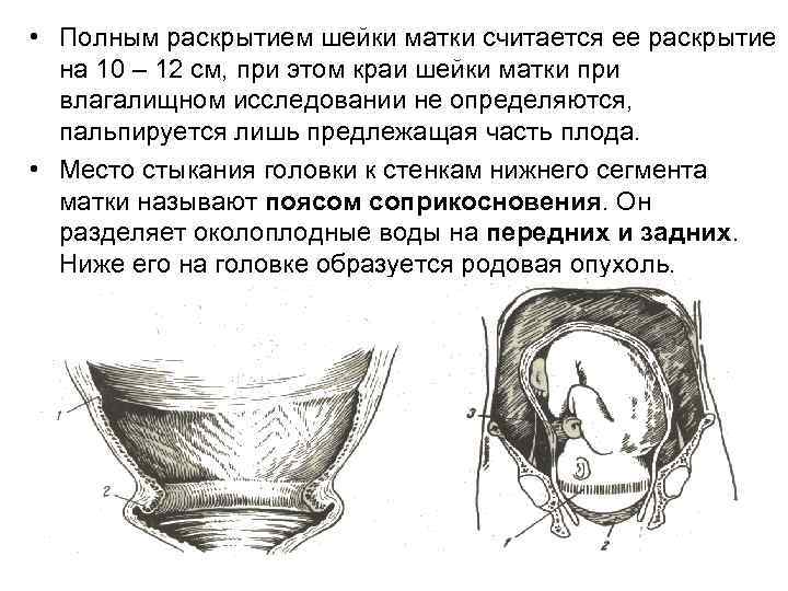 Ведение беременности у женщин с рубцом на матке
