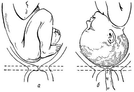 Роды после конизации шейки матки: возможно ли это?