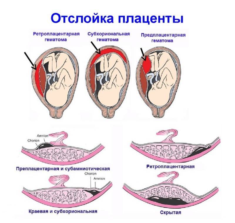 Пгд эмбрионов, преимплантационная генетическая диагностика эмбрионов