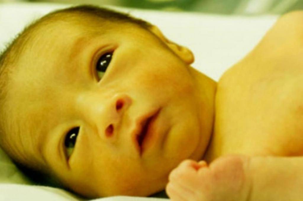 Гипербилирубинемия (желтуха) у новорожденных детей
