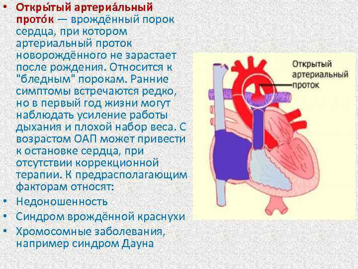 Открытый артериальный проток (ОАП) сердца у детей
