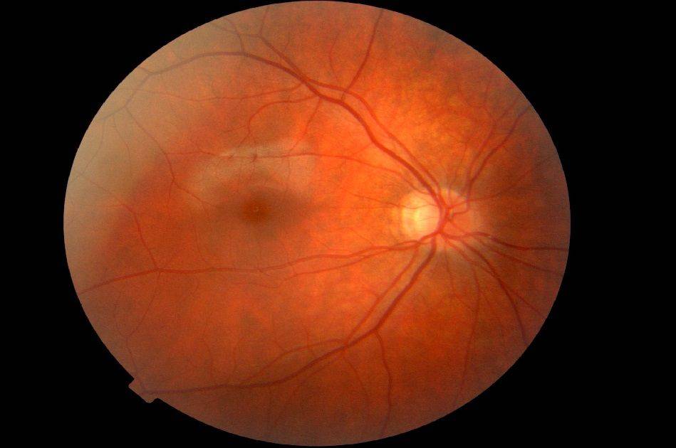 Лечение макулодистрофии сетчатки глаза в москве. стоимость лечения макулодистрофии в клинике с.федорова